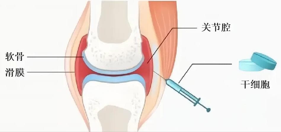 间充质干细胞：关节炎患者的福音？