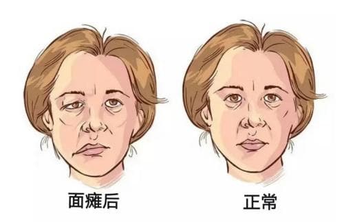 长沙市中心医院：多学科协作治愈罕见面神经炎病例