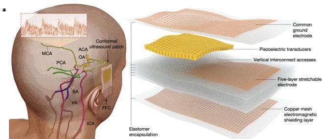 徐升团队发布新型超声贴片，实现3D脑血流监测突破