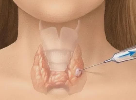 体检查出甲状腺结节后，什么情况下需要做穿刺活检？
