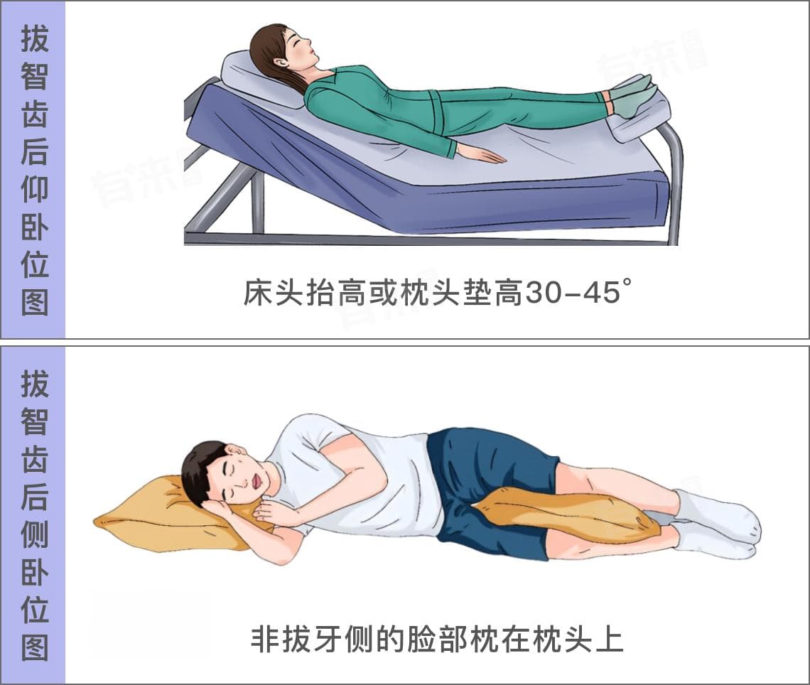 拔智齿后睡觉姿势有需要注意的吗