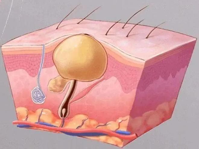 一文了解常见体表肿物——皮脂腺囊肿