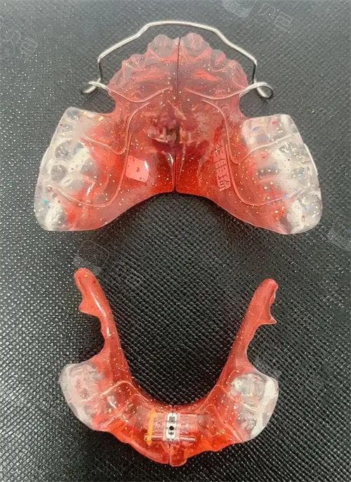 戴颌垫能让关节复位吗？专业解析颌垫治疗效果与注意事项