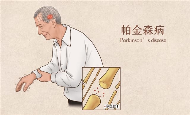 帕金森病与运动：保持活力的秘诀