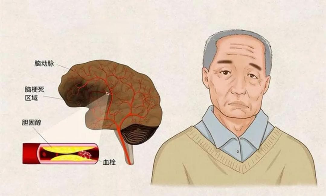 轻松掌握脑梗死：从识别到预防的全面指南
