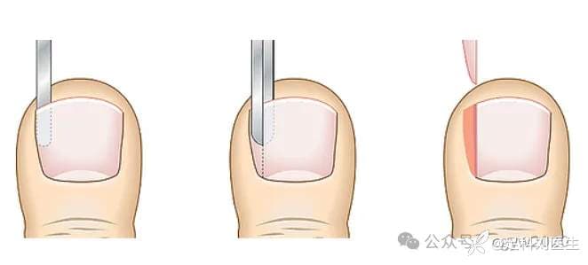 甲沟炎手术怎么做？一篇文章跟你说清楚！！！