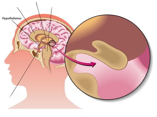 女性垂体腺瘤的五大症状及应对方法