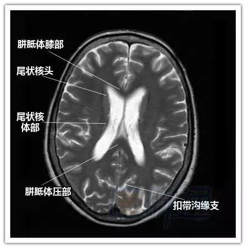 简明易懂的脑部断层解剖图谱，快来收藏！