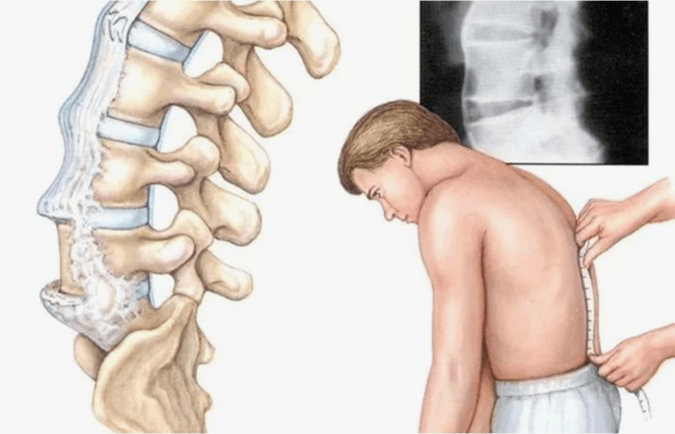 强直性脊柱炎：什么情况下才考虑使用生物制剂？