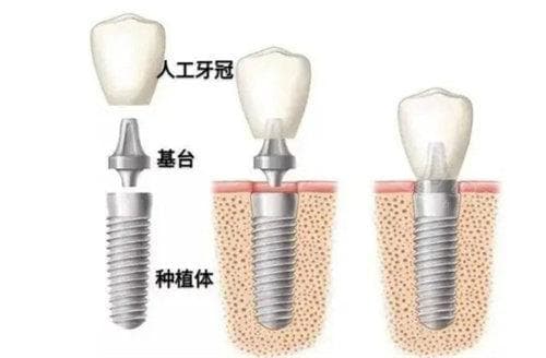 种植牙咀嚼功能怎么样?从咬合力/舒适性/美观性综合解析种植牙咀嚼功能