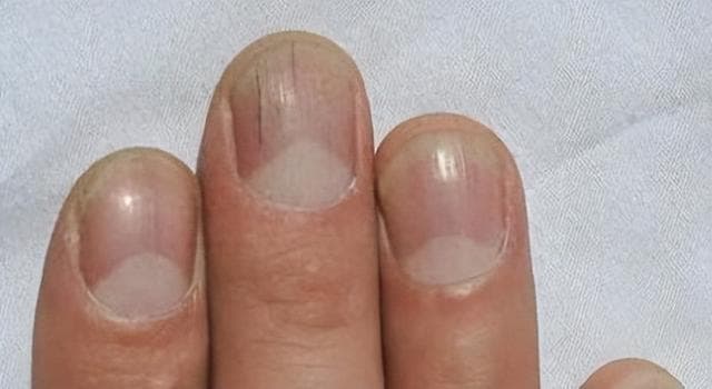 指甲上有一条条的竖纹，是生病了吗？如果是这种提醒，要当心