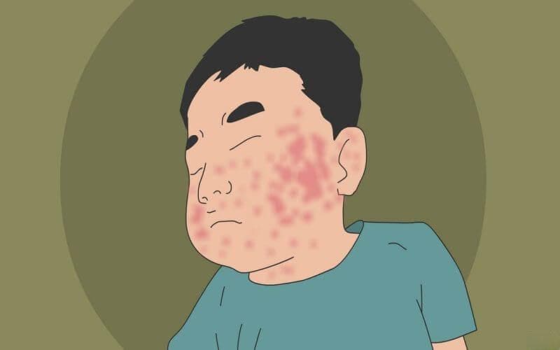 科普：3分钟知悉急性荨麻疹能不能接种流感疫苗