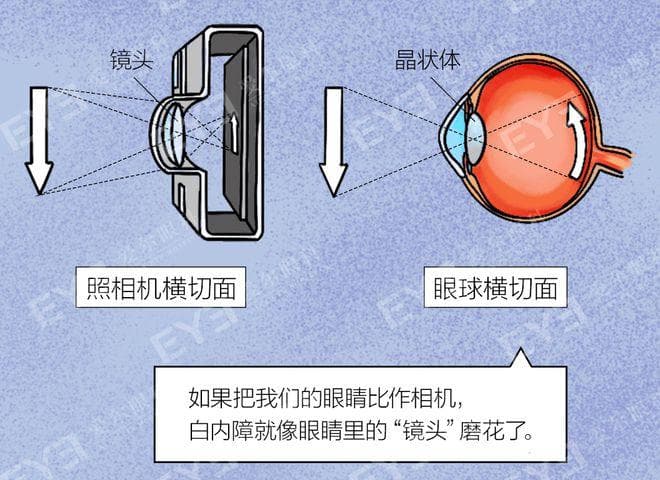 两亿人都会得的白内障，对糖尿病患者来说有啥影响？