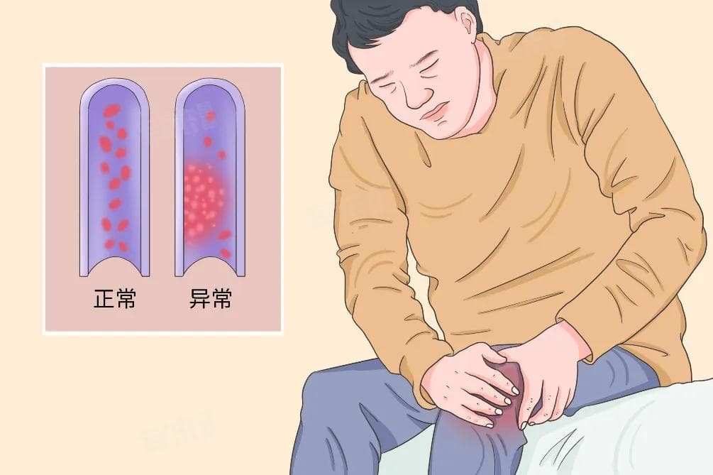 下肢静脉血栓如何治疗