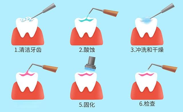 窝沟封闭怎么做？详细步骤与注意事项全解析
