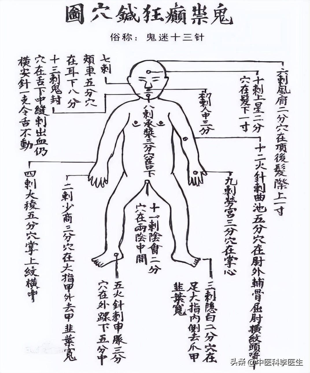 中医针灸的“绝技”——鬼门十三针，治急症和邪病，可惜快失传了