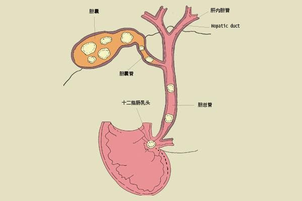 胆结石患者看过来！要不要切除胆囊？切除后还能正常生活吗？