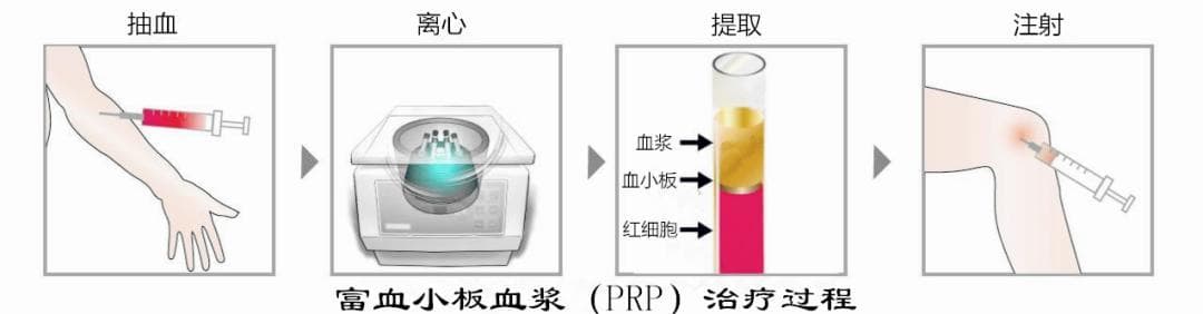 膝关节软骨损伤的四种手术治疗方法