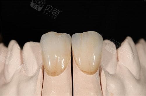 包牙冠多少钱一颗?全方面解析包冠牙齿的费用,根据材质价格500~8000元都有!