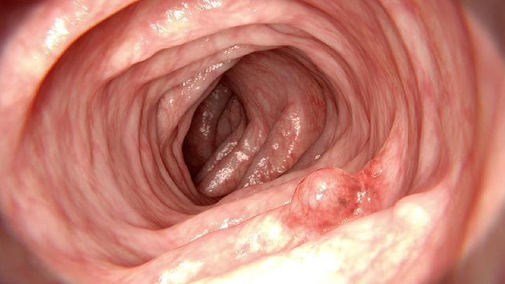 唾液腺囊肿能自愈吗？医生：自愈概率不到5%，多数需医疗干预