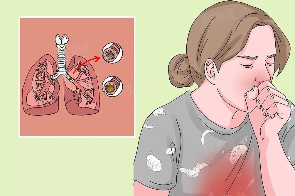 孕妇咳嗽厉害怎么办最有效