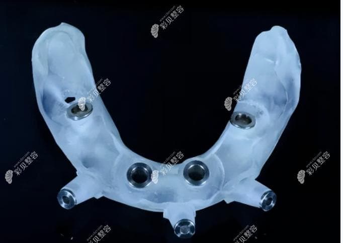 导板种植牙与普通种植牙价格差多少?3d导板vs传统种牙哪个好