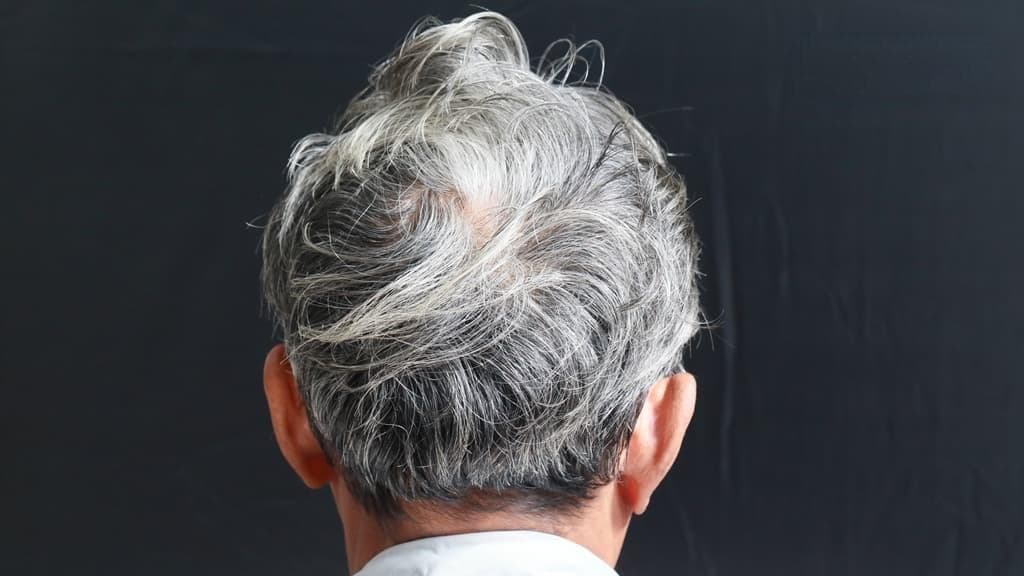 他30歲像50歲！白髮能逆轉？醫曝8招對抗白髮