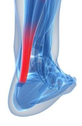 你曾有过跑步跟腱痛吗？体院教授如是说（上篇）