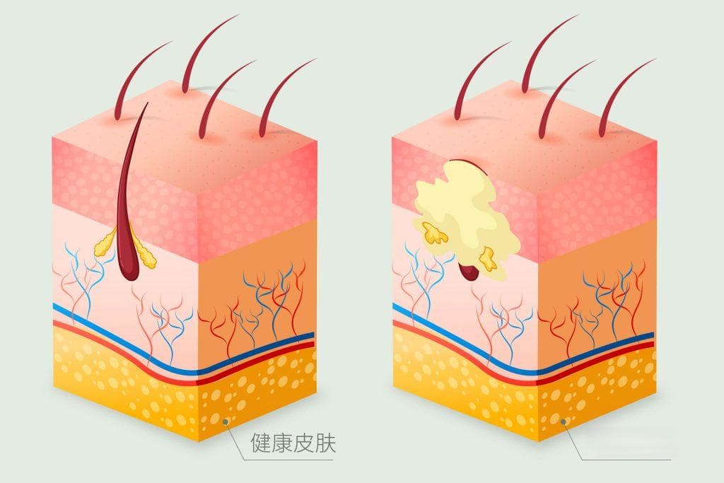 痘痘救星：全面攻略讓您輕松處理頑固痘痘