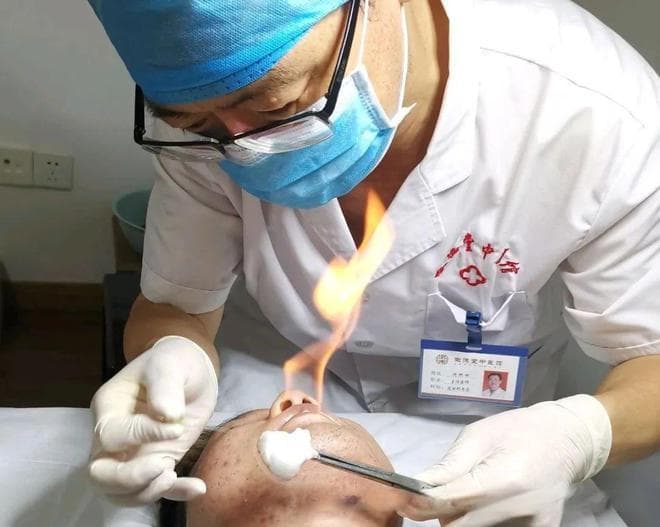 中医火针疗法在面部痤疮治疗中的应用