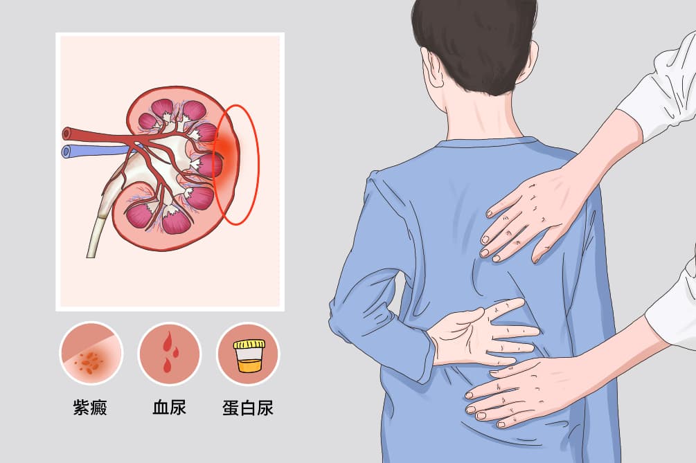 小儿紫癜性肾炎