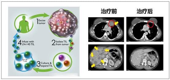 肿瘤免疫疗法大盘点：哪些靠谱？哪些是忽悠？