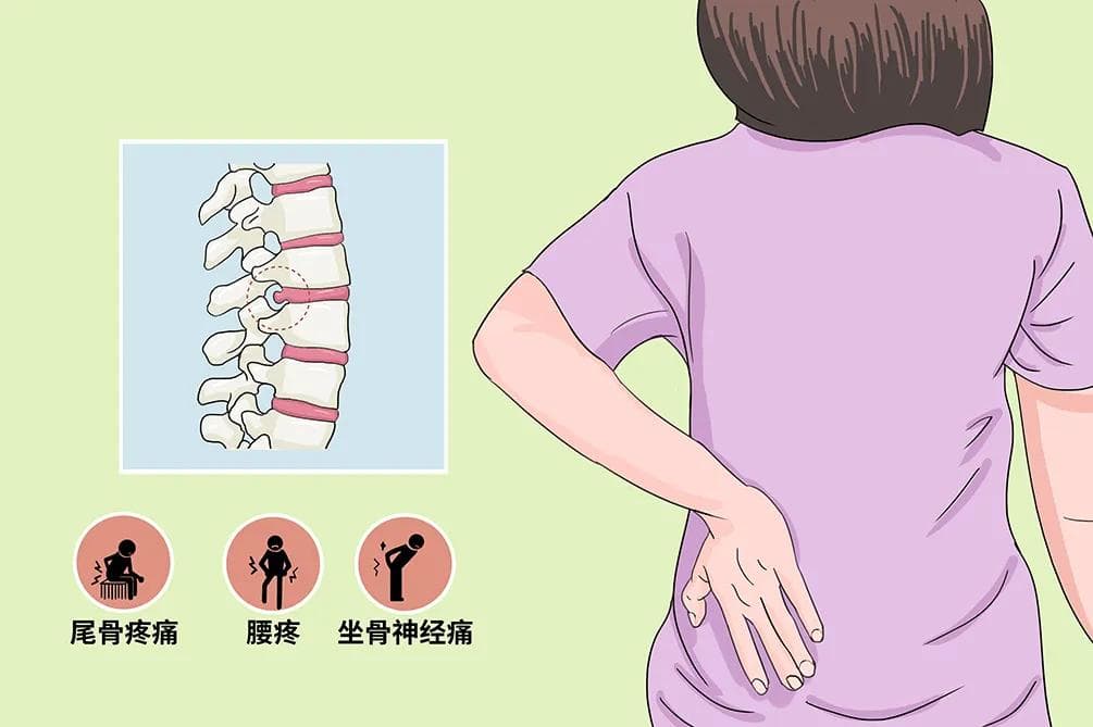 腰椎间盘突出腿疼最快缓解方法