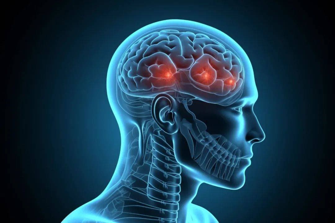 体检有“缺血灶”是大脑缺血了？有“腔梗灶”是得了脑梗死？｜世界卒中日