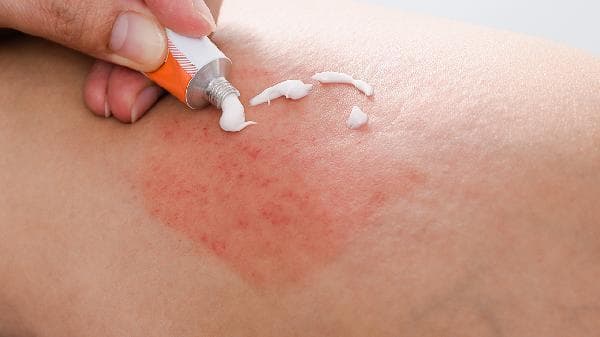 皮肤过敏出现红疹怎么办？原因、症状与治疗全解析