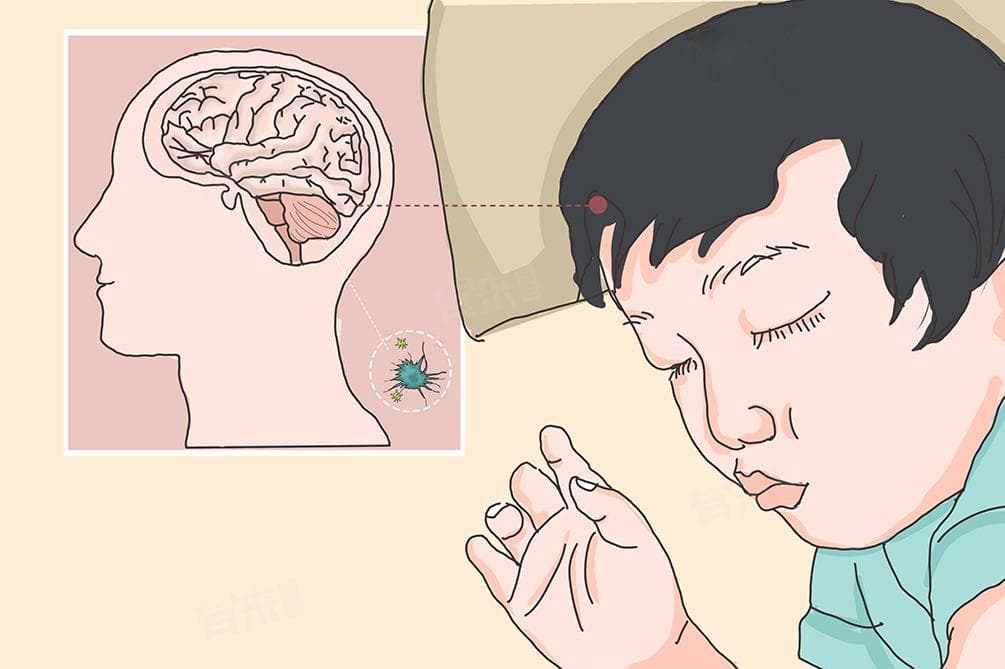病毒性脑膜炎的治疗方案