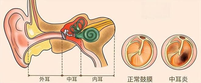 耳痛、听力减退，小心中耳炎，6个月-3岁儿童最易中招