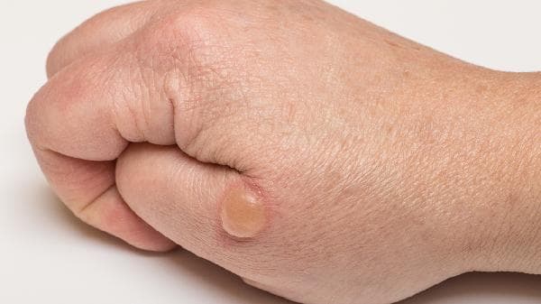 水痘带状疱疹病毒：从症状识别到科学防治