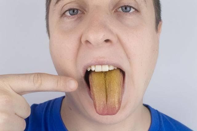 舌苔发黄厚是什么原因?口博仕医学院研究院正规吗？