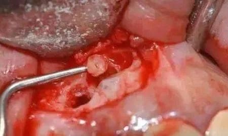 高清图文：根尖切除术操作全过程