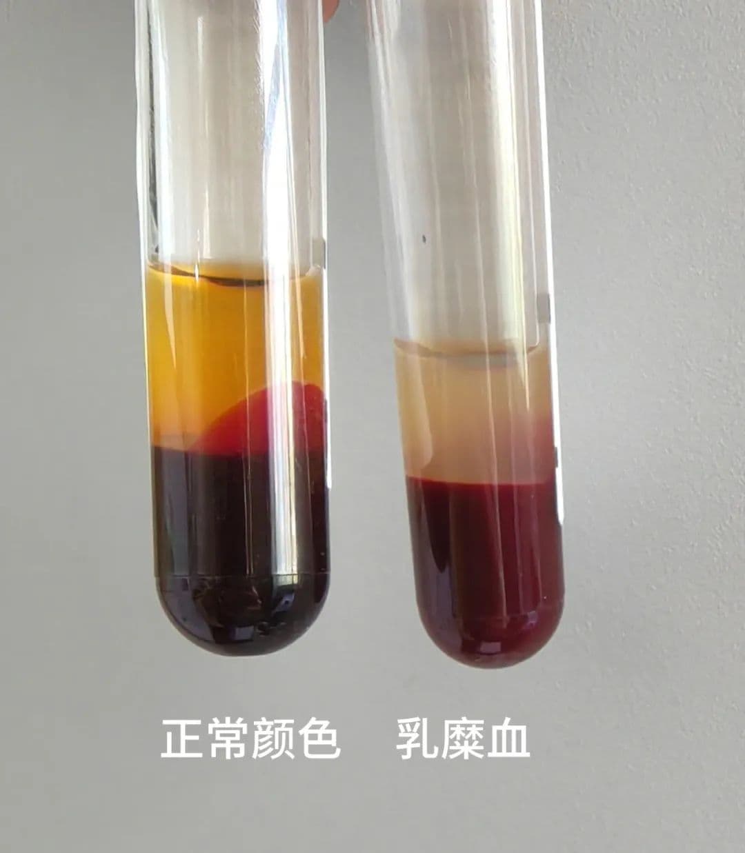 “乳糜血”的真相：形成原因、危害及预防方法