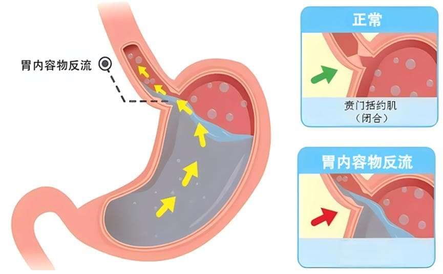 止不住的烧心？别再让他困扰你！