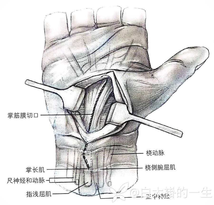 腕管综合征（CTS）诊疗指南