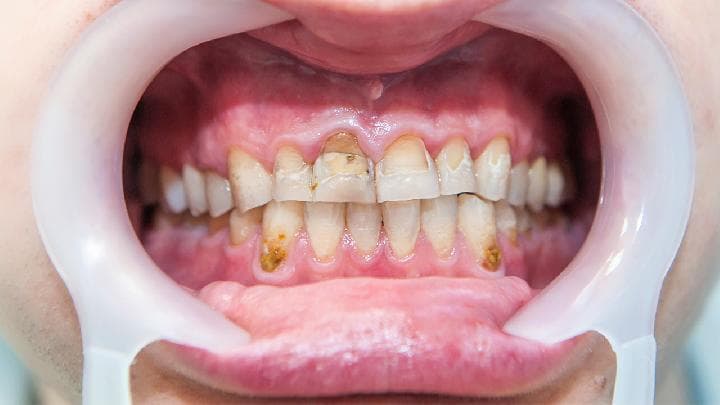 牙龈肿痛可以吃牛黄解毒片吗？专业解析病因与用药指南