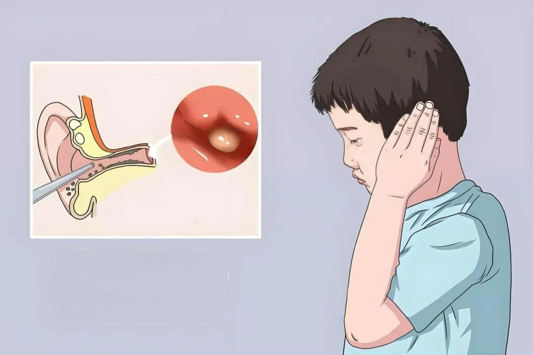 耳朵里的小世界：中耳炎，你了解多少？