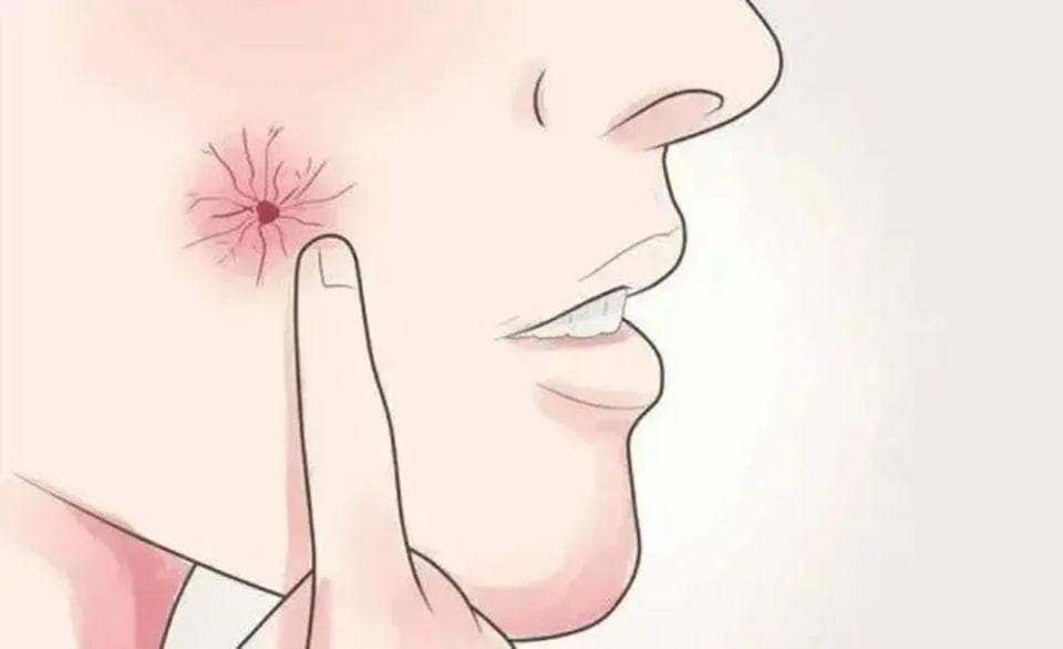 身上出现这种“痣”，多半是被肝病“盯”上了！尽早识别或能救命