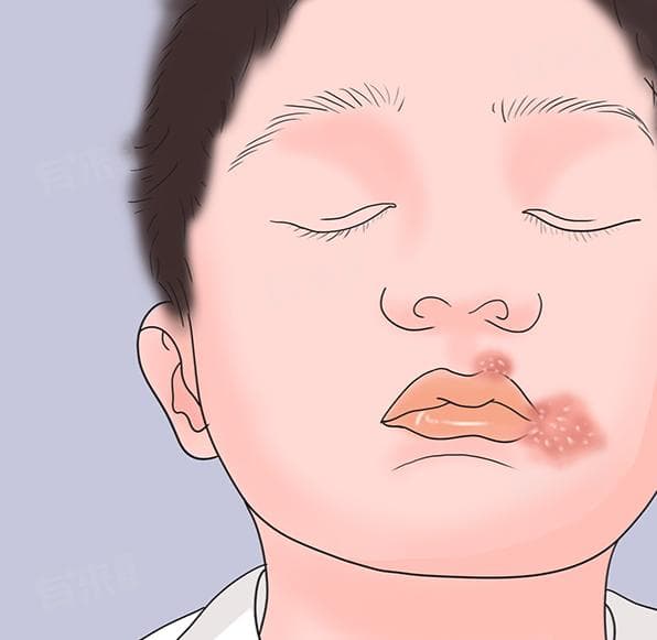 嘴角长了一堆小疙瘩怎么办？可能的原因及预防方法