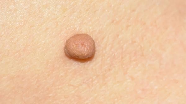 鼻咽血管纤维瘤：症状、诊断与治疗全解析