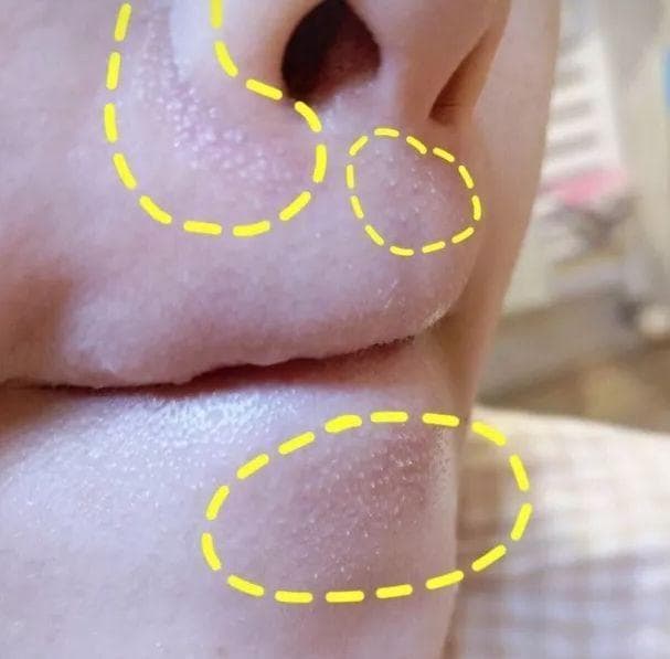 下巴凸起的小颗粒千万别抠！多种原因及处理方法详解