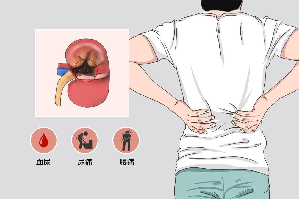 肾脏肿瘤的最佳治疗方法